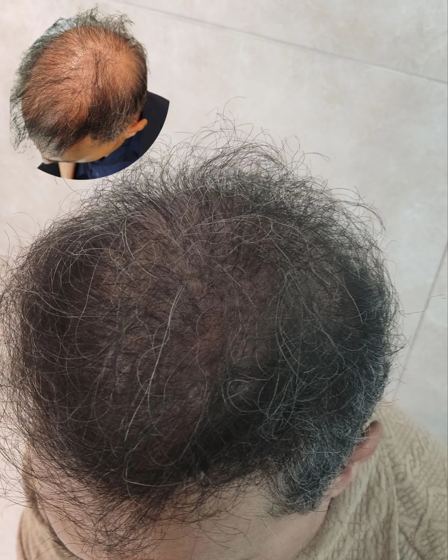 نمونه میکرواسکالپ